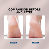 CallusRemover™ - Genießen Sie weiche und jünger aussehende Füße